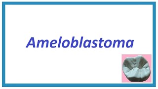 Ameloblastoma  Important points  Odontogenic Tumours 1  Oral Pathology [upl. by Danziger]