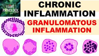 INFLAMMATION Part 9 Chronic Inflammation  GRANULOMATOUS INFLAMMATION [upl. by Eusoj]