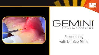 Frenectomy  How to Use the Gemini™ Laser [upl. by Elianore]