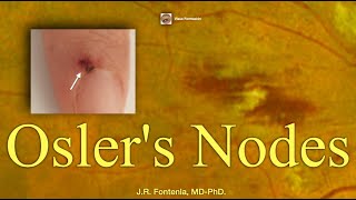 Oslers Nodes Bacterial Endocarditis [upl. by Wadsworth536]