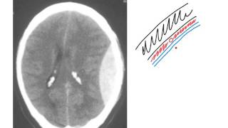 Extradural haemorrhage [upl. by Myrle]