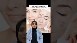 Solution of acne scars and acne marks  pimples  free medical advice Day11 skintreatment [upl. by Anielram209]