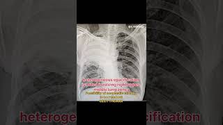 Heterogeneous opacification chest lungs abnormal radiology shortvideo [upl. by Oidacra980]