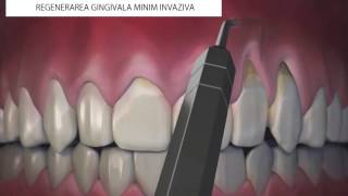 Regenerare gingivala minim invaziva [upl. by Tomaso]