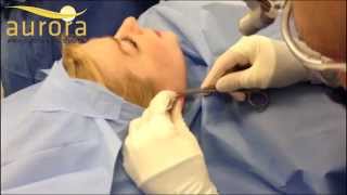 Split Earlobe Repair  Aurora Clinics [upl. by Silra547]