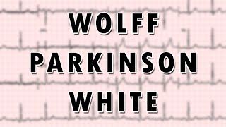 WolffParkinsonWhite Syndrome [upl. by Vassaux]