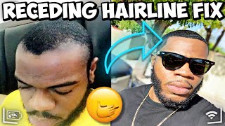 HOW TO FIX A RECEDING  THINNING HAIRLINE  IN 30 DAYS  😱😱🤯 [upl. by Yila]