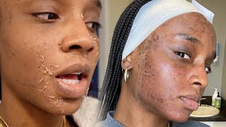 CHEMICAL PEEL  VAMPIRE FACIAL  Full Process  Procedure  Peeling  Before amp After [upl. by Assener]