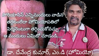 సోరియాసిస్ హోమియోపతి చికిత్సPsoriasis Homeopathy Treatment [upl. by Luapnoj]