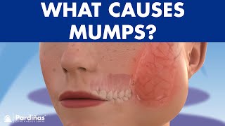 Mumps parotitis and other salivary glands conditions sialadenitis sialolithiasis mucocele © [upl. by Humpage]