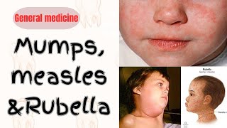 MumpsMeaslesRubellaMMR vaccinekopliks spotdental medicine surgeryday bds mmr vaccine [upl. by Alrac966]