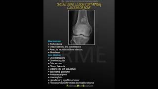 Lucent bone lesion containing calcium or bone [upl. by Rosecan]