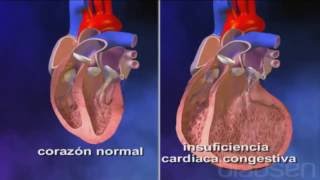 Insuficiencia Cardiaca Congestiva [upl. by Lincoln133]