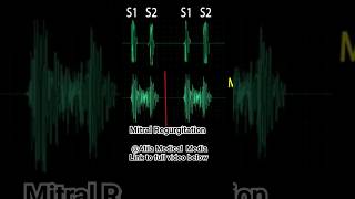 Heart Murmurs Mitral Valve Regurgitation heartmurmurs medicalanimation [upl. by Choo]