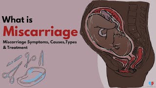 What is Miscarriage  Miscarriage Symptoms Causes Types amp Treatment  Med About You [upl. by Ihcekn]