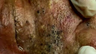 PIMPLE Popping BLACKHEAD REMOVAL 2022 ACNE Treatment TOP RELAXING SPA VIDEO 2022 19 [upl. by Dihgirb]