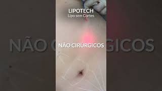 Quer tratar a gordura abdominal em pouco tempo Conheça a Lipotech lipotech verao2024 endolift [upl. by Eirb]