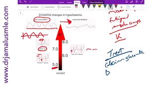 Hyperkalemia on ECG diagnosis and management  Dr Jamal USMLE [upl. by Gnah]