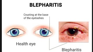 Blepharitis  Introduction Causes Symptoms Diagnosis And Complications [upl. by Okiruy]