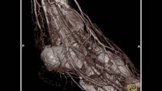 Vascular CT angiography of the lower extremity3 of 3 [upl. by Derreg]