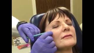 Wrinkle Treatment Dysport Filler for Crows Feet Wrinkles Near Eyes [upl. by Joris]