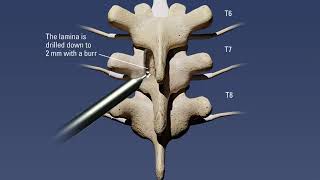 Thoracic laminectomy procedure with removal of ossified ligamentum flavum [upl. by Alexis816]