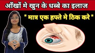 Sub Cunjuctiva Hemorrhage Treatment  Ankho Me khun ke Lal Dhabbe Ka Ilaz  In Hindi [upl. by Neeruan]