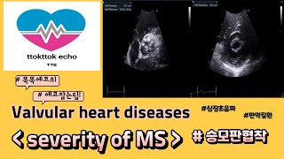 승모판협착 중증도 평가 mitral stenosis severity echocardiography 심장초음파 heart echo view 판막질환 승모판협착 [upl. by Sylvester455]