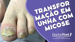 TRANFORMAÇÃO INCRÍVEL EM UNHA COM MICOSE [upl. by Varick681]