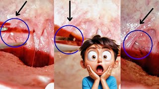 Tonsil Stone Removal Procedure Irritable but Difficult to remove why it Fails [upl. by Samella]