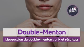 CHIRURGIE ESTHÉTIQUE  🙋🏻‍♀️Liposuccion du doublementon  prix et résultats  BODYEXPERT [upl. by Otrebcire]