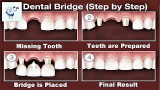 Dental Bridge Procedure Step by Step [upl. by Adekahs]