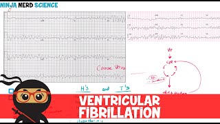 Rate and Rhythm  Ventricular Fibrillation [upl. by Nalyac]