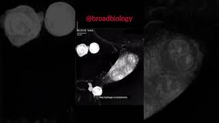 Macrophage vs lymphoma microscopic animation biologyvideo [upl. by Cohdwell]