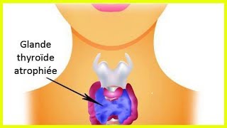 L’hypothyroïdie  comment prendre soin de sa thyroïde [upl. by Guinn774]