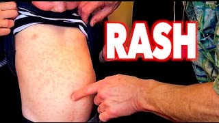 GREAT LOOKING RASH Full Body  Dr Paul [upl. by Yerg371]