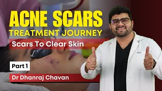 🛑LIVE Part 1  Watch Our Patients Acne Scar Treatment  Best Treatment for Acne and Acne Scars Pune [upl. by Suiddaht306]