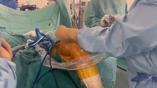 Arthroscopic Confirmation of Femoral Button Deployment During Posterior Cruciate Ligament Reconstruc [upl. by Amluz112]