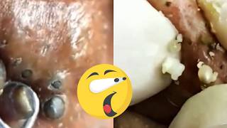 Unbelievably Satisfying Blackhead and Pimple Removals 😱Skincare Acne Blackheads [upl. by Nimzaj]