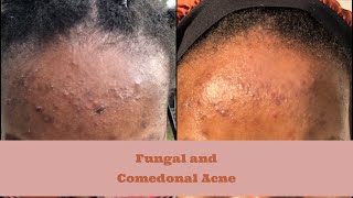 Clearing up my Fungal and Comedonal Forehead Acne  Skin Diary  Routine  Malassezia Folliculitis [upl. by Attenol168]