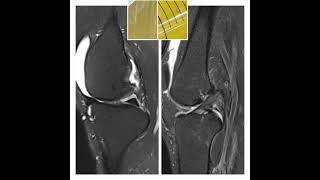 Gouty arthritis VS Degenerative arthritis [upl. by Kessel]