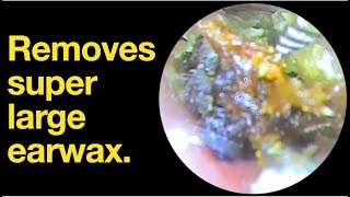 Removes super large earwax ear wax removal  ear cleaning  ASMR  relaxation  relax [upl. by Jabe]