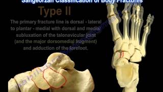 Navicular Fractures  Everything You Need To Know  Dr Nabil Ebraheim [upl. by Linkoski]