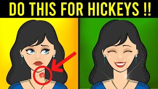 How To Get Rid Of Hickeys Fast Naturally  2022 [upl. by Nerol377]