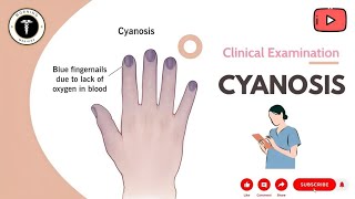 Cyanosis Explained Symptoms Causes amp Emergency Management  Medical Insights [upl. by Nirret]