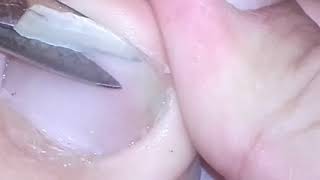 Cutting my big toenail when it starts to get stuck [upl. by Ellac]