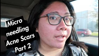 Microneedling Acne Scars Second Treatment Update amp Skin Ceuticals [upl. by Johnstone500]