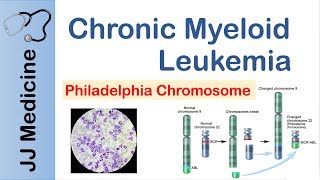 Chronic Myeloid Leukemia CML  Pathogenesis Symptoms and Treatment [upl. by Spiers]