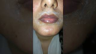 Angular Cheilitis Treatment skincare angularcheilitis antifungal shorts youtubeshorts cure [upl. by Hillard]