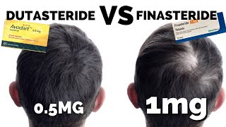 Dutasteride Mega Guide  Better Than Finasteride [upl. by Derian56]